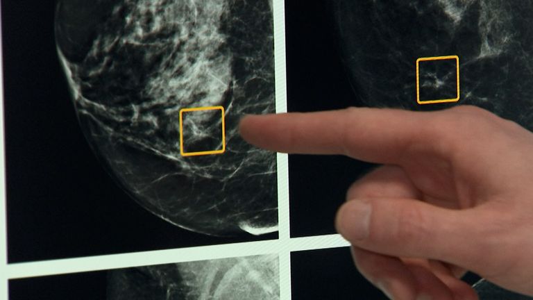 A trial using artificial intelligence in breast cancer screening will take place in April with around 700,000 women expected to take part.