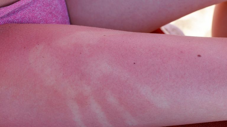 Sunburn isn’t just red skin – here’s what’s happening underneath the burn | Science, Climate & Tech News