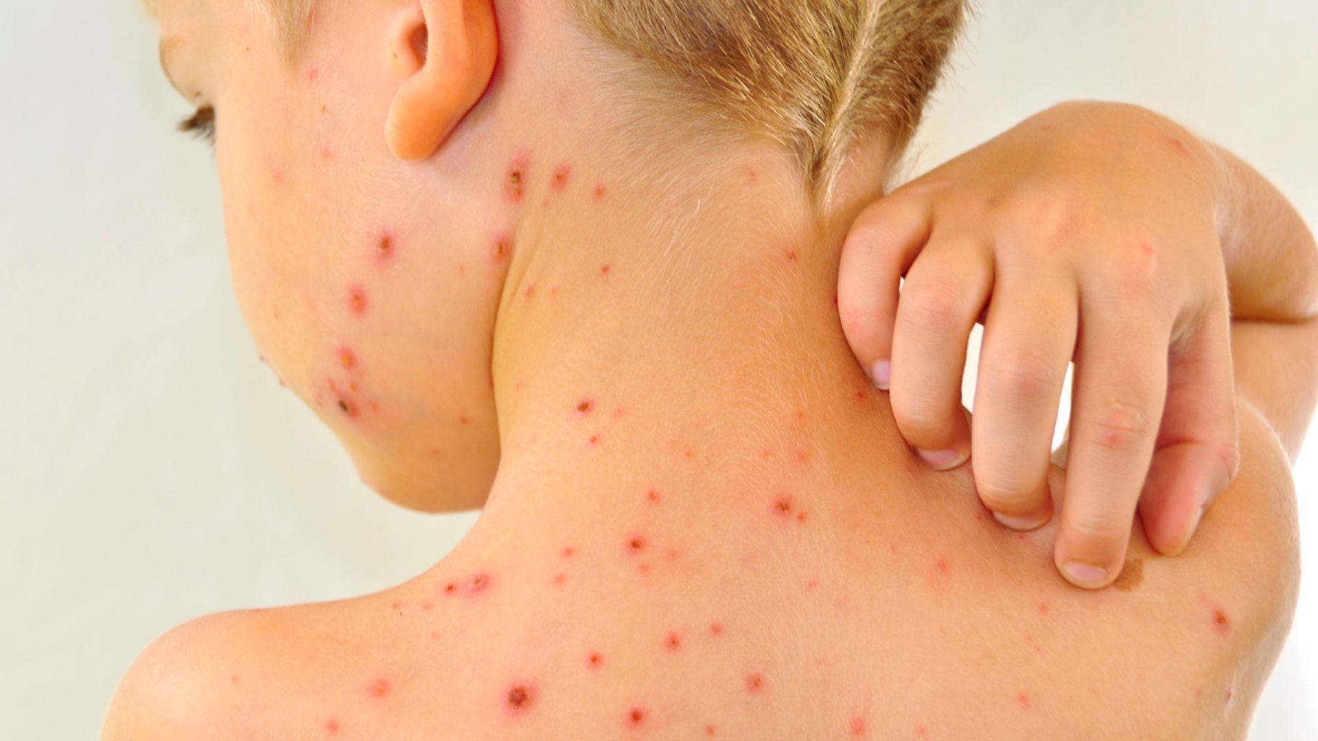 Chickenpox vaccine to be offered on NHS next year, as part of routine MMR jab for babies | Science, Climate & Tech News